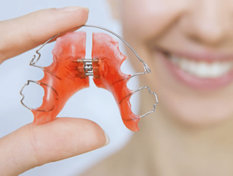 Orthodontic Expanders