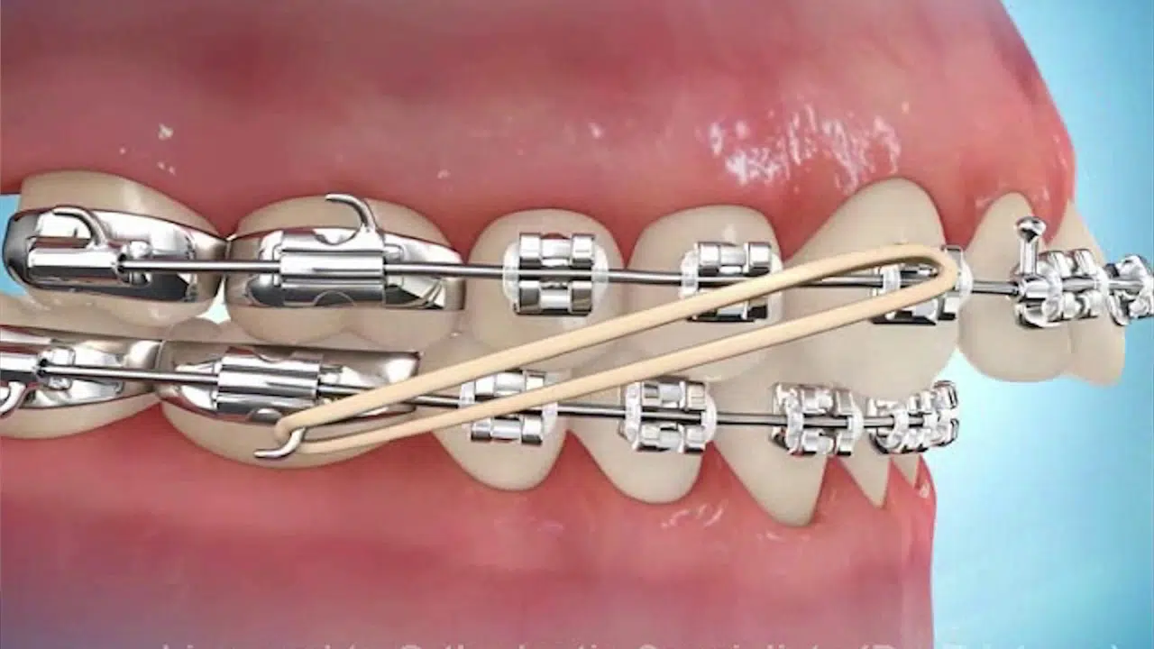 The Different Types Of Rubber Bands For Braces