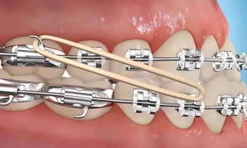 What are elastics and what do they do? - Rick Herrmann Orthodontics
