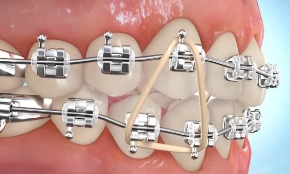 What are elastics and what do they do? - Rick Herrmann Orthodontics