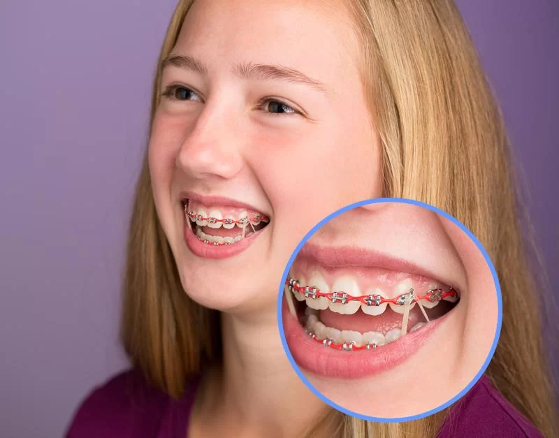 What Are the Rubber Bands for Braces Used For?