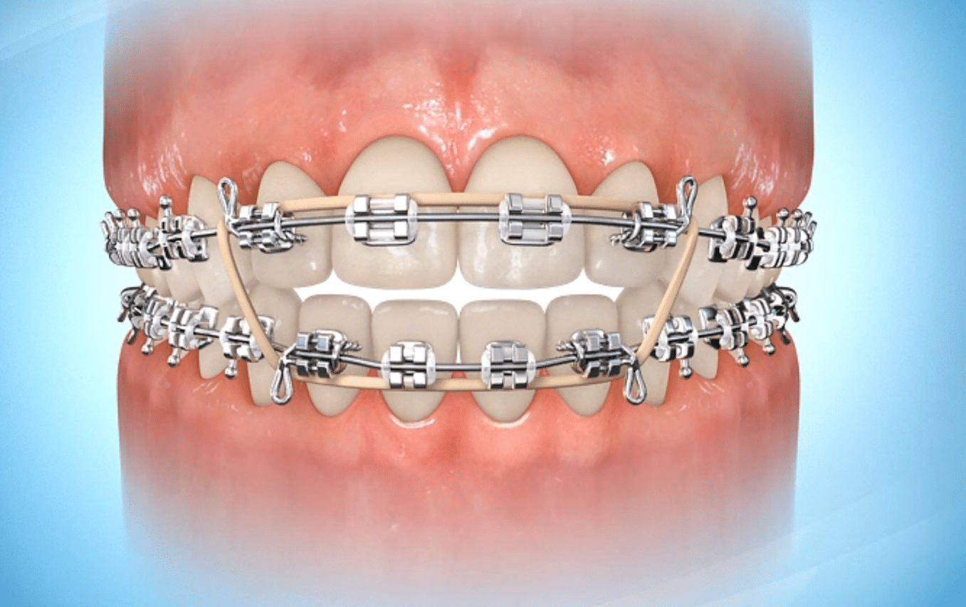 Rubber Bands For Braces: Helpful Tips And Tricks