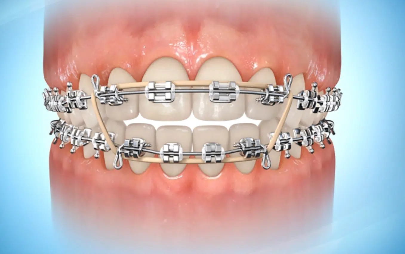 How elastics / rubber bands move teeth (time lapse) - Braces